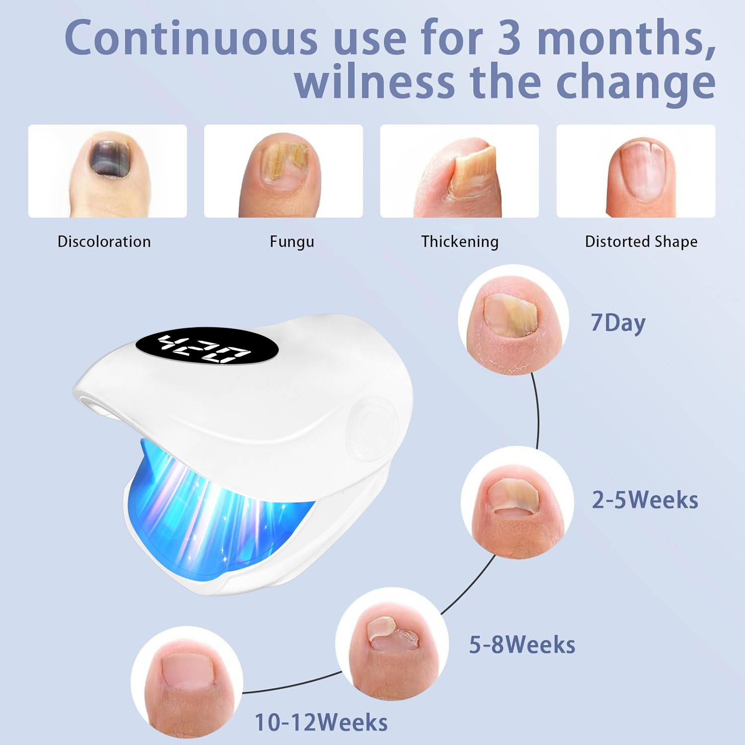 อุปกรณ์รักษาเชื้อราที่เล็บแบบช - Galvanic Skin Sensor บทวิจารณ์และราคา